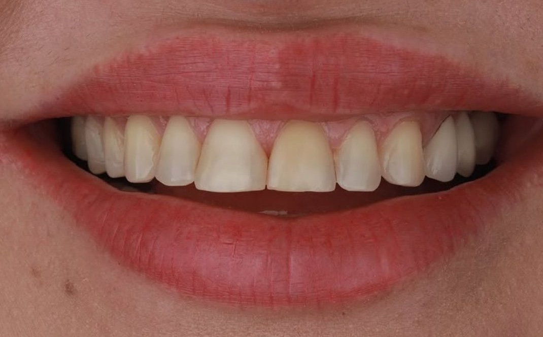 Antes