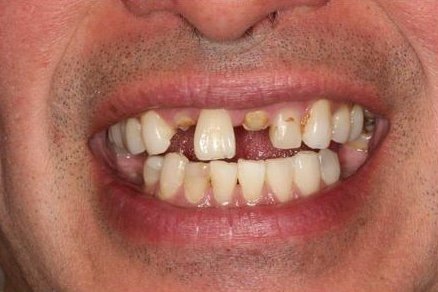 Antes